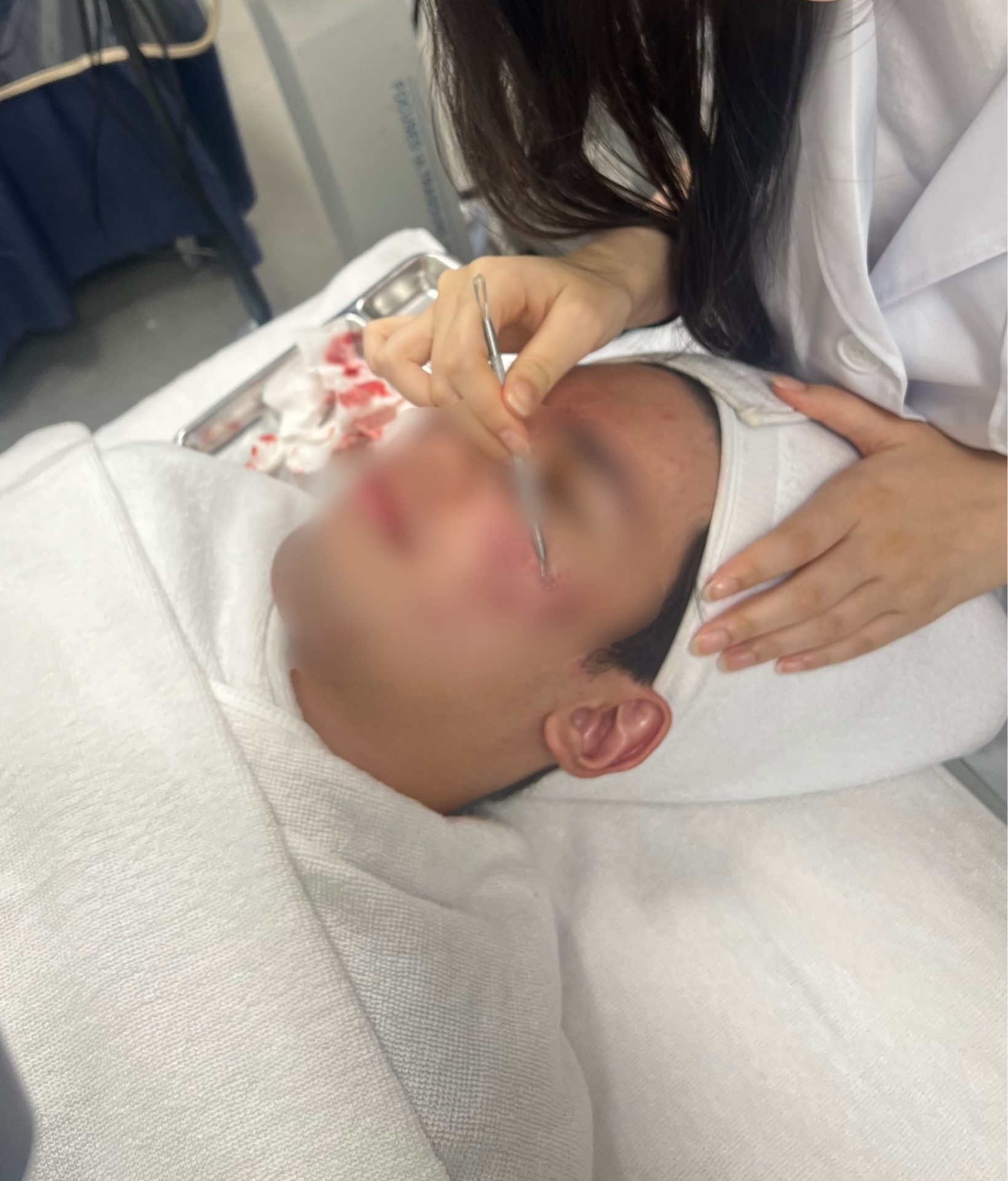 여드름 압출 테크닉 사진 2